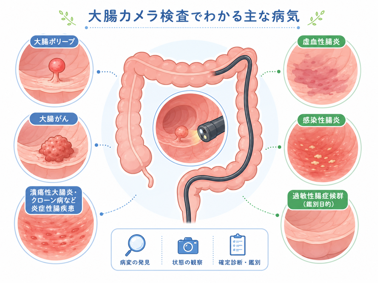 大腸カメラ検査でわかる主な病気