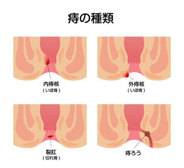 痔の種類